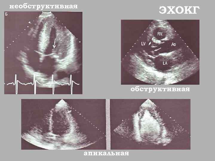 необструктивная ЭХОКГ обструктивная апикальная 