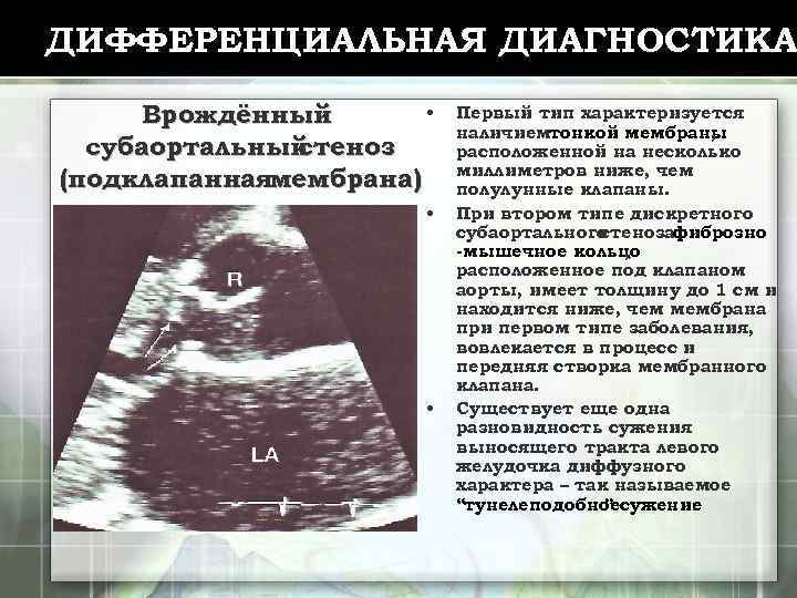 ДИФФЕРЕНЦИАЛЬНАЯ ДИАГНОСТИКА • Врождённый субаортальный стеноз (подклапаннаямембрана) • • Первый тип характеризуется наличиемтонкой мембраны