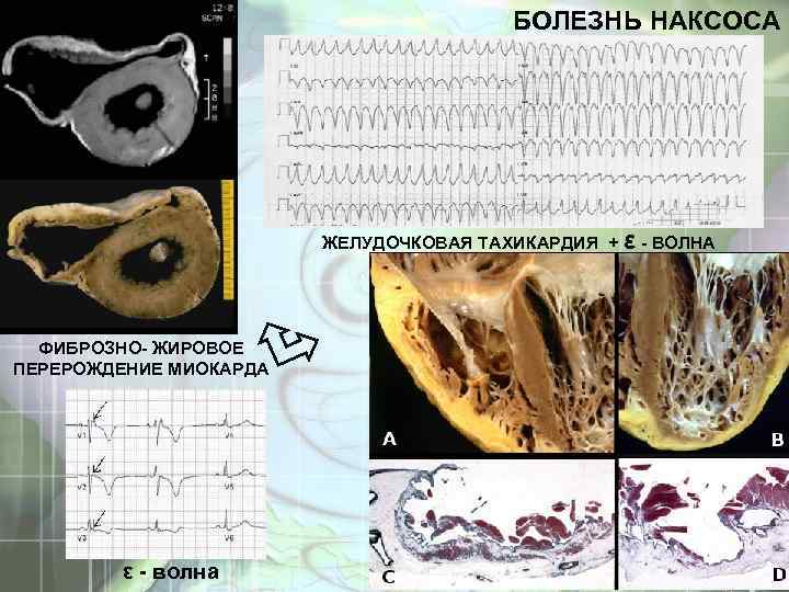 БОЛЕЗНЬ НАКСОСА ЖЕЛУДОЧКОВАЯ ТАХИКАРДИЯ + ε - ВОЛНА ФИБРОЗНО- ЖИРОВОЕ ПЕРЕРОЖДЕНИЕ МИОКАРДА ε -