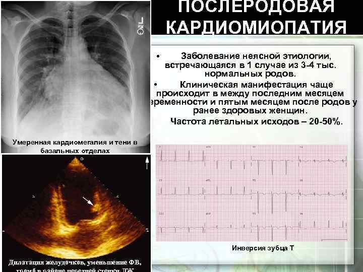 ПОСЛЕРОДОВАЯ КАРДИОМИОПАТИЯ Заболевание неясной этиологии, встречающаяся в 1 случае из 3 -4 тыс. нормальных