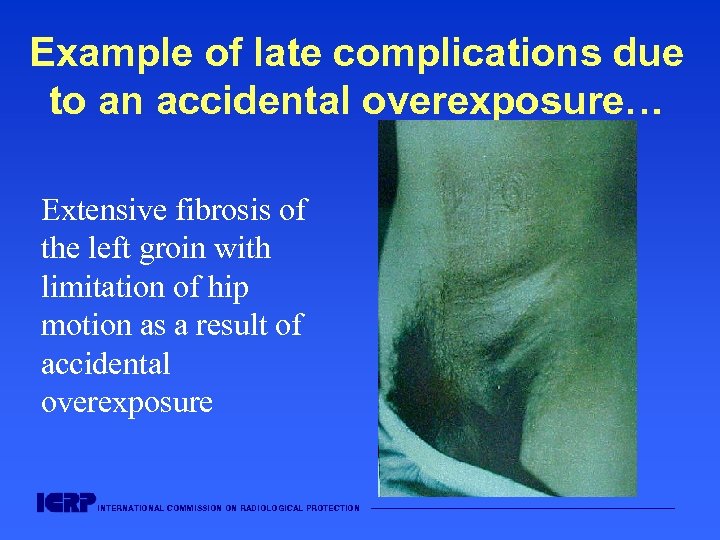 Example of late complications due to an accidental overexposure… Extensive fibrosis of the left