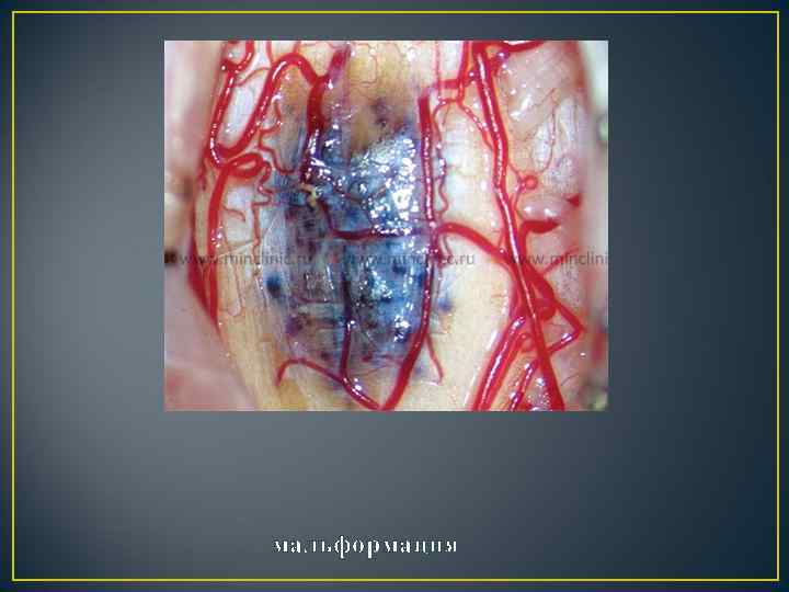 мальформация 