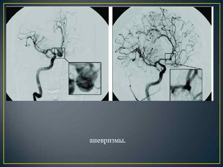 аневризмы. 
