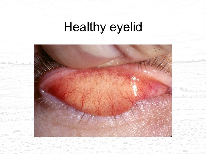 Healthy eyelid 