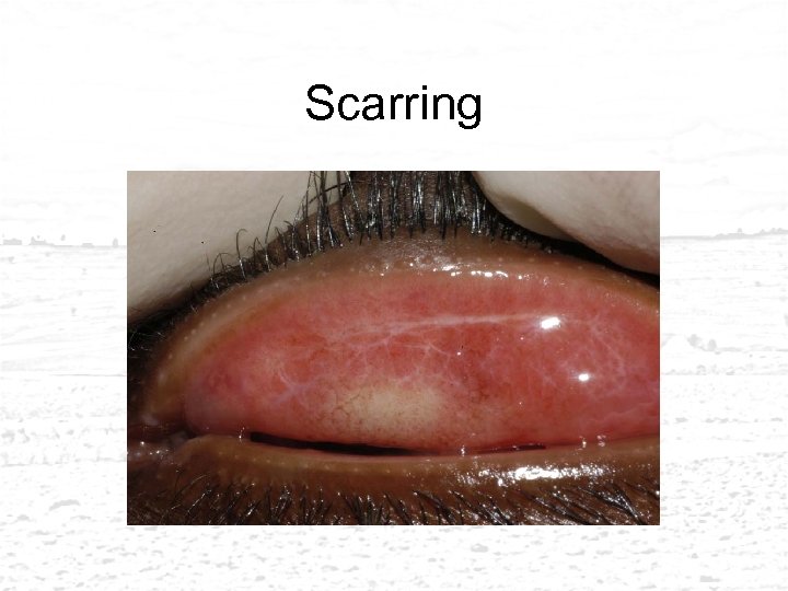 Scarring 