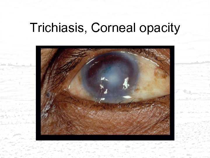 Trichiasis, Corneal opacity 