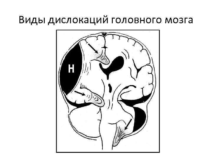 Виды дислокаций головного мозга 