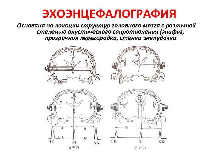 ЭХОЭНЦЕФАЛОГРАФИЯ Основана на локации структур головного мозга с различной степенью акустического сопротивления (эпифиз, прозрачная