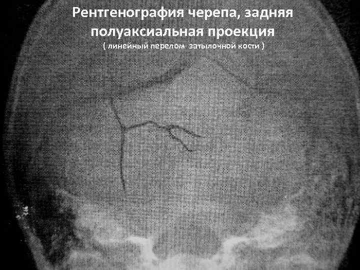 Рентгенография черепа, задняя полуаксиальная проекция ( линейный перелом затылочной кости ) 