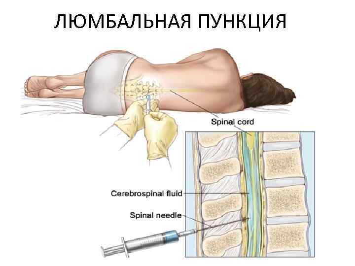 ЛЮМБАЛЬНАЯ ПУНКЦИЯ 