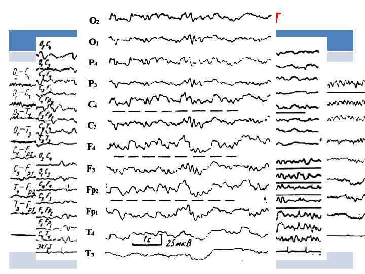 Изменения на ЭЭГ при ЧМТ степень ЧМТ Характеристика не отмечается грубых нарушений электрических процессов