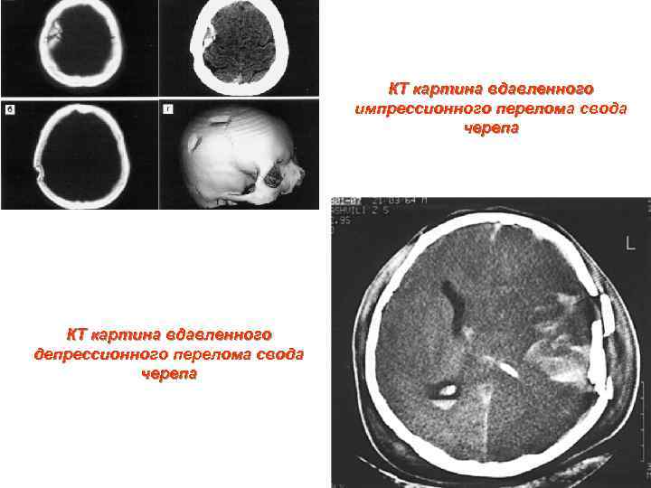 КТ картина вдавленного импрессионного перелома свода черепа КТ картина вдавленного депрессионного перелома свода черепа