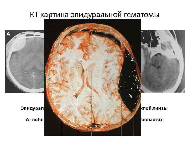 КТ картина эпидуральной гематомы 