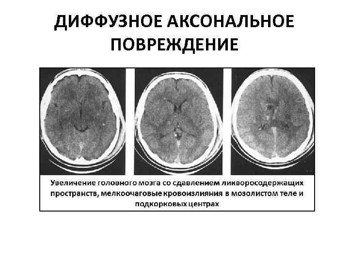 ДИФФУЗНОЕ АКСОНАЛЬНОЕ ПОВРЕЖДЕНИЕ 