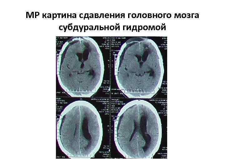 МР картина сдавления головного мозга субдуральной гидромой 