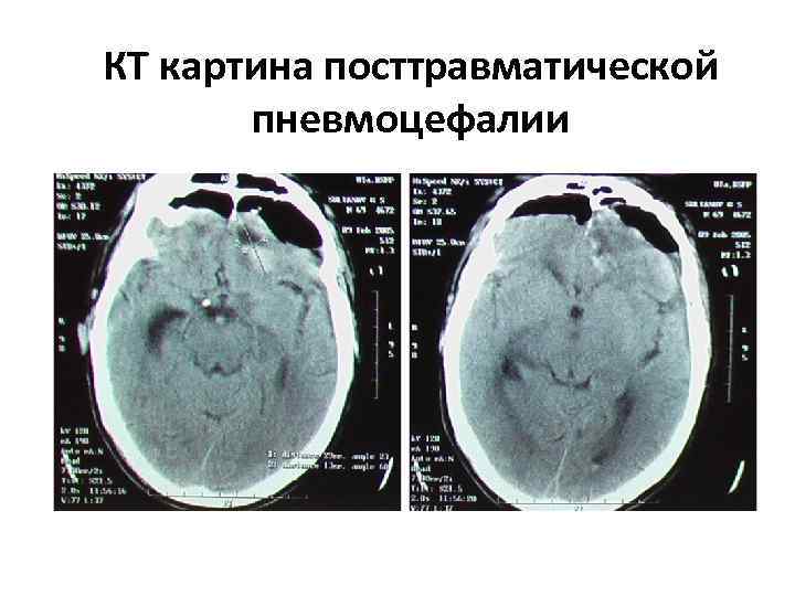 КТ картина посттравматической пневмоцефалии 