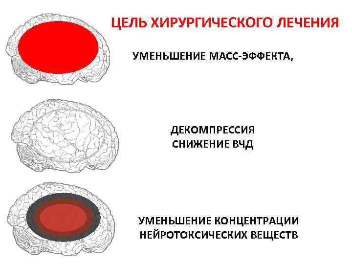 ЦЕЛЬ ХИРУРГИЧЕСКОГО ЛЕЧЕНИЯ УМЕНЬШЕНИЕ МАСС-ЭФФЕКТА, ДЕКОМПРЕССИЯ СНИЖЕНИЕ ВЧД УМЕНЬШЕНИЕ КОНЦЕНТРАЦИИ НЕЙРОТОКСИЧЕСКИХ ВЕЩЕСТВ 