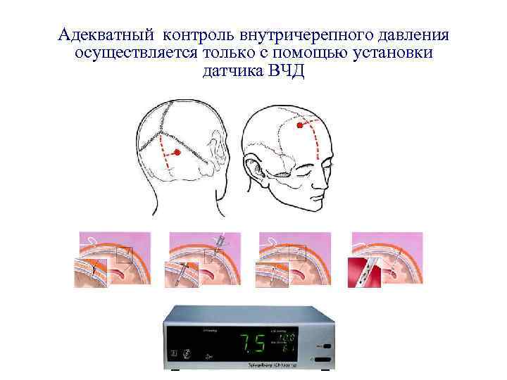 Адекватный контроль внутричерепного давления осуществляется только с помощью установки датчика ВЧД 