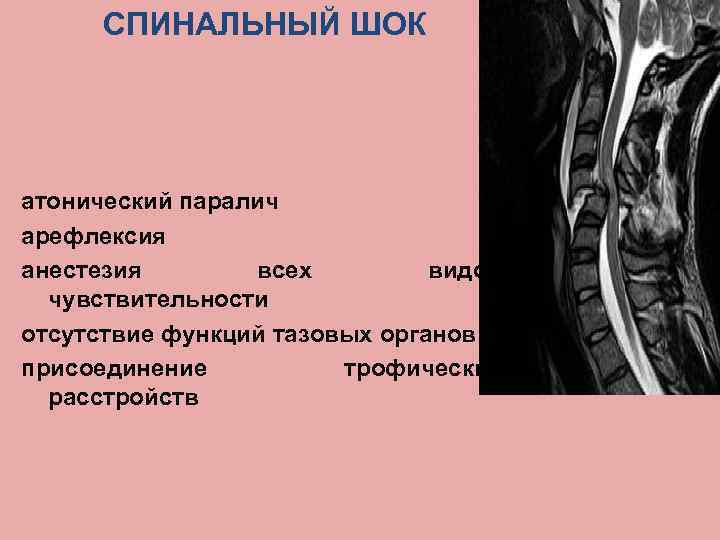 СПИНАЛЬНЫЙ ШОК атонический паралич арефлексия анестезия всех видов чувствительности отсутствие функций тазовых органов присоединение