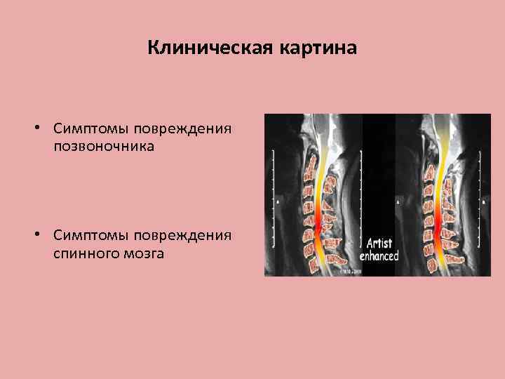 Клиническая картина • Симптомы повреждения позвоночника • Симптомы повреждения спинного мозга 