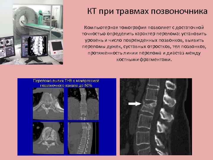 КТ при травмах позвоночника Компьютерная томография позволяет с достаточной точностью определить характер перелома: установить