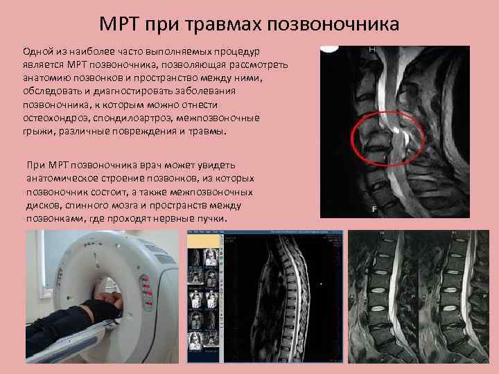 МРТ при травмах позвоночника Одной из наиболее часто выполняемых процедур является МРТ позвоночника, позволяющая