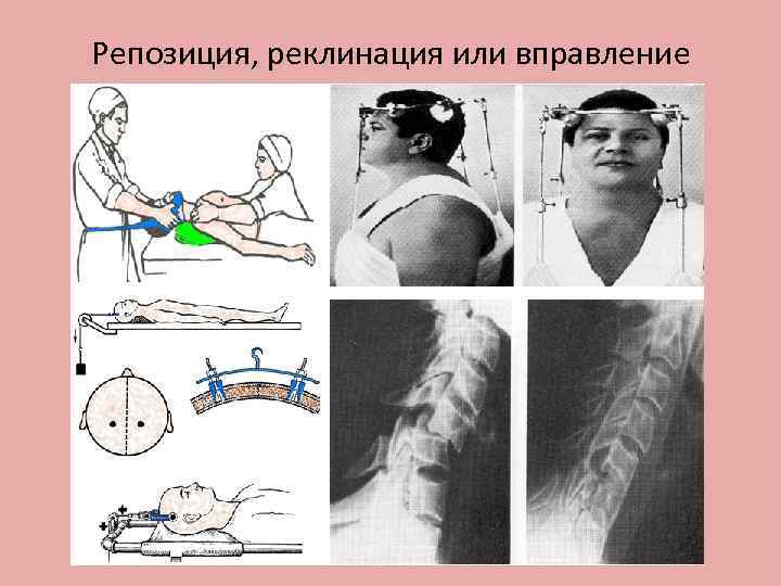 Репозиция, реклинация или вправление 