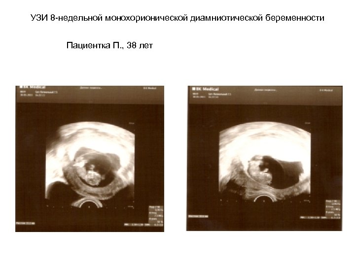 УЗИ 8 -недельной монохорионической диамниотической беременности Пациентка П. , 38 лет 
