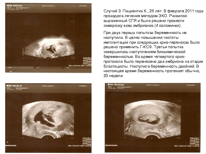 Случай 3. Пациентка К. , 26 лет. В феврале 2011 года проходила лечение методом