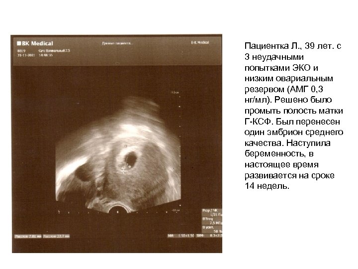 Пациентка Л. , 39 лет. с 3 неудачными попытками ЭКО и низким овариальным резервом