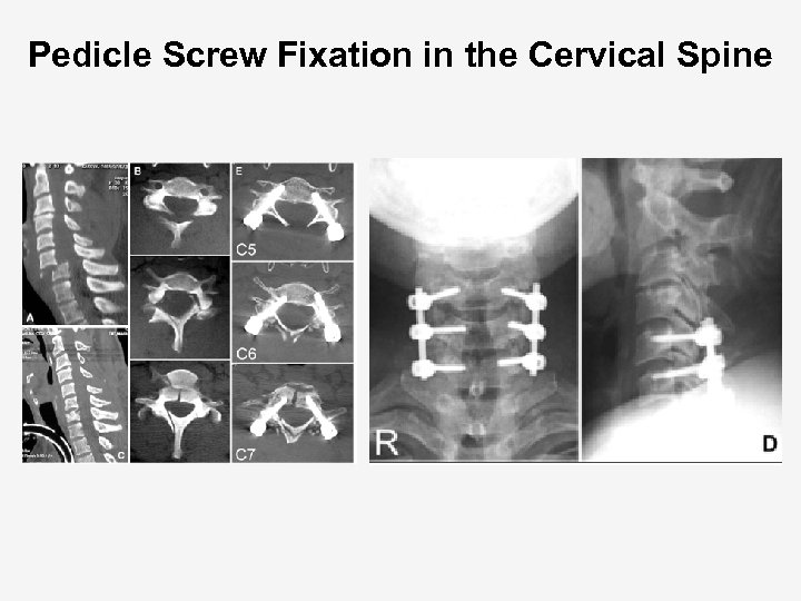 Pedicle Screw Fixation in the Cervical Spine 