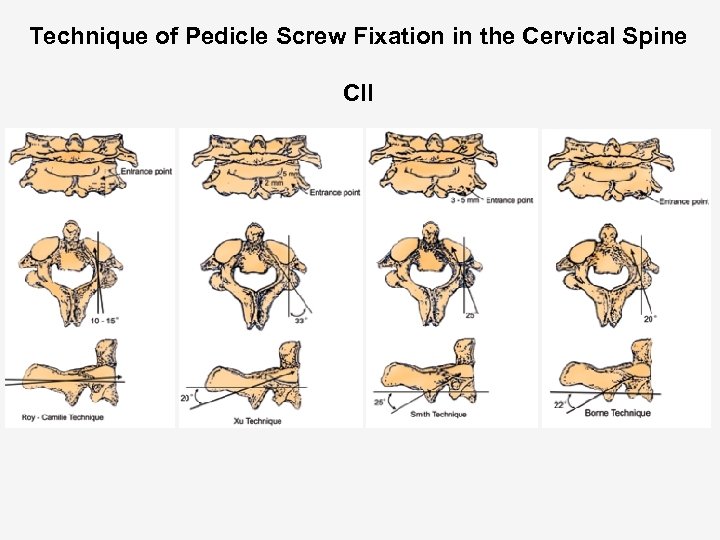 Technique of Pedicle Screw Fixation in the Cervical Spine CII 