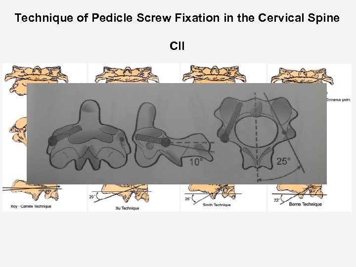 Technique of Pedicle Screw Fixation in the Cervical Spine CII 