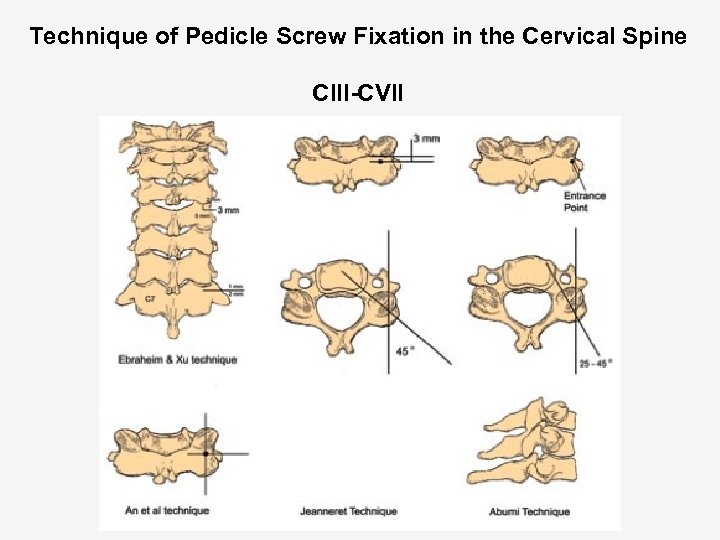 Technique of Pedicle Screw Fixation in the Cervical Spine CIII-CVII 