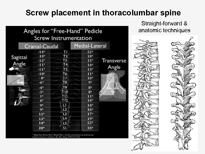 Screw placement in thoracolumbar spine Straight-forward & anatomic techniques 