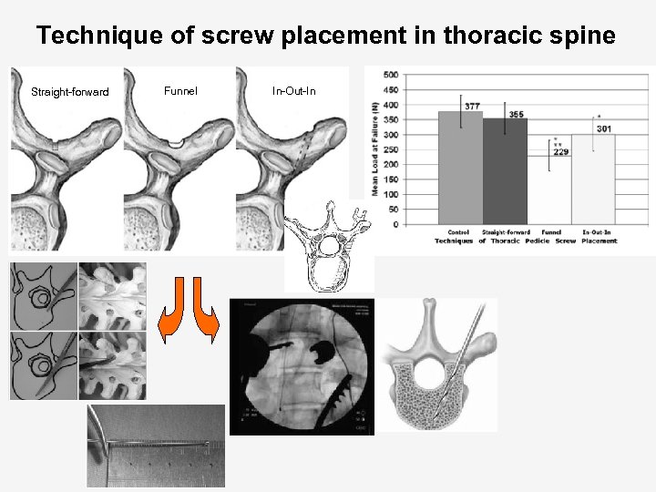 Technique of screw placement in thoracic spine Straight-forward Funnel In-Out-In 