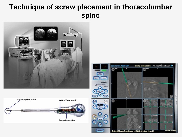 Technique of screw placement in thoracolumbar spine 