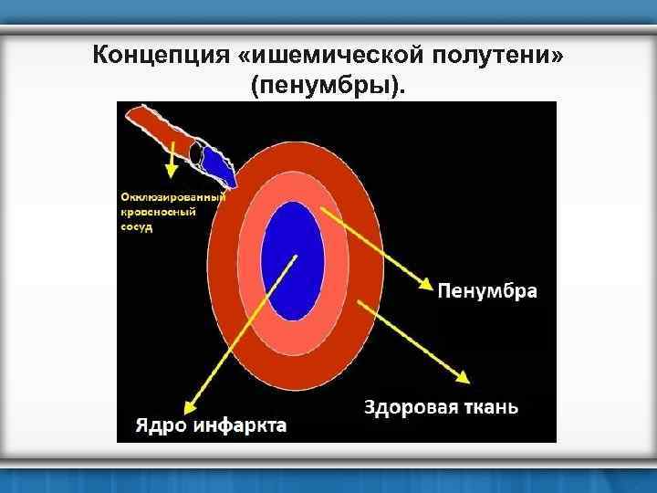 Концепция «ишемической полутени» (пенумбры). 