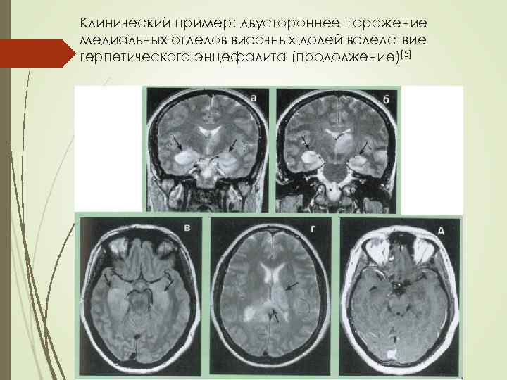 Клинический пример: двустороннее поражение медиальных отделов височных долей вследствие герпетического энцефалита (продолжение)[5] 