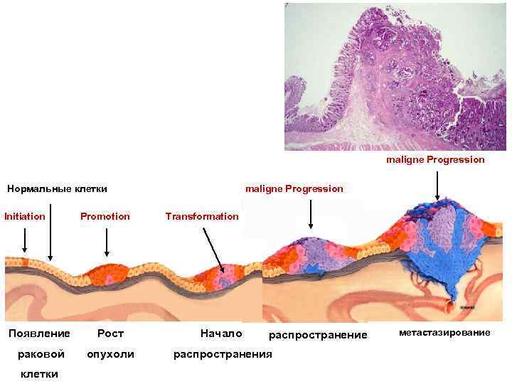 maligne Progression Нормальные клетки Initiation Promotion Transformation Появление Рост Начало раковой опухоли распространения клетки