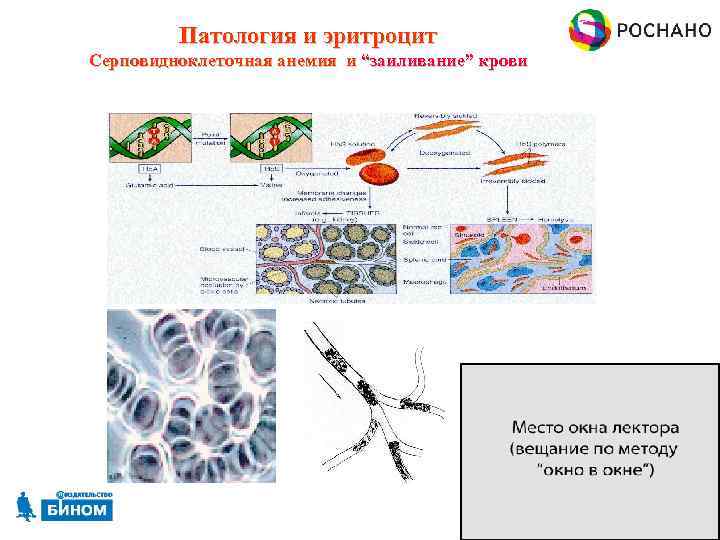 Патология и эритроцит Серповидноклеточная анемия и “заиливание” крови 