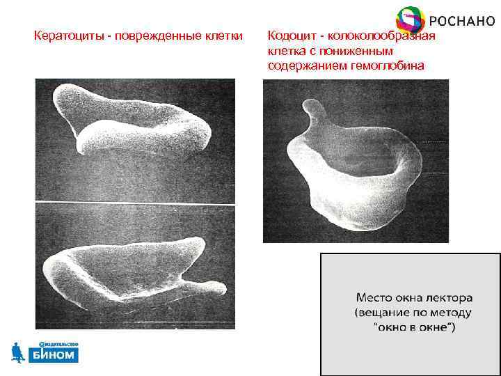 Кератоциты - поврежденные клетки Кодоцит - колообразная клетка с пониженным содержанием гемоглобина 