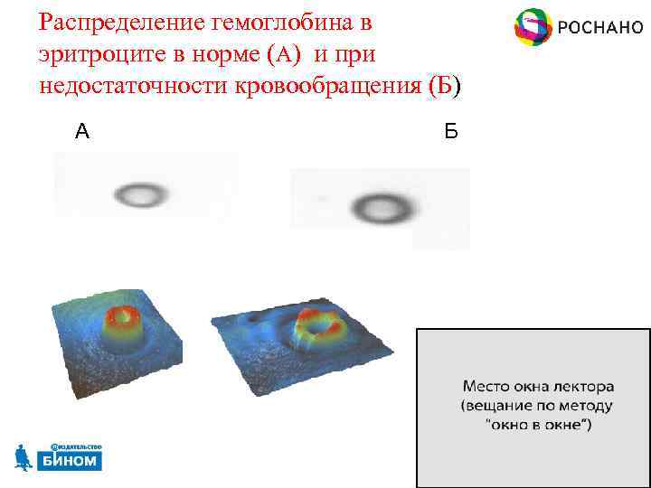 Распределение гемоглобина в эритроците в норме (А) и при недостаточности кровообращения (Б) А Б