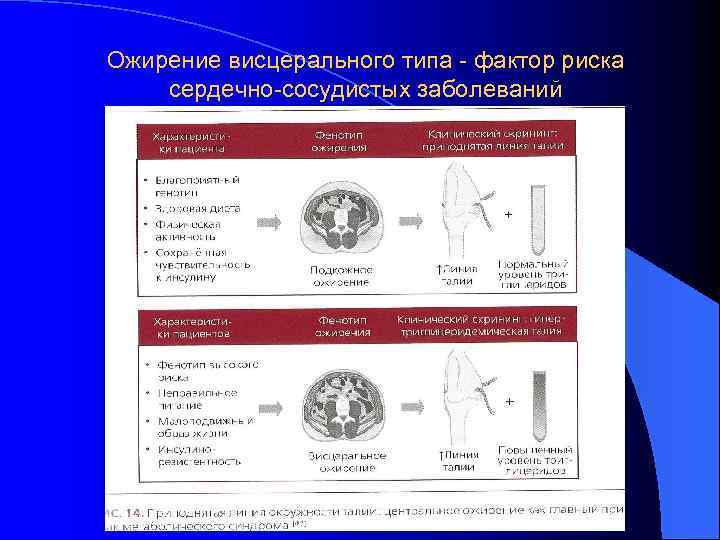 Ожирение висцерального типа - фактор риска сердечно-сосудистых заболеваний 