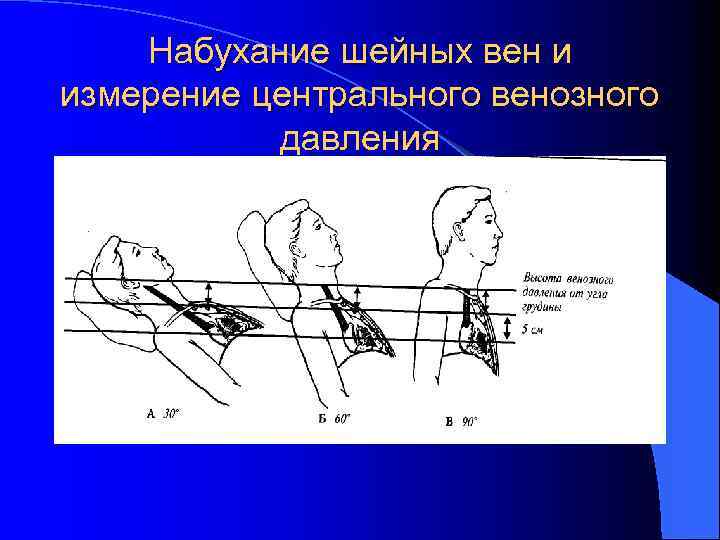 Метод измерения венозного давления. Набухание вен способ определения. Набухание и пульсация шейных вен. Набухание шейных вен причины.