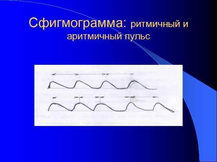 Сфигмограмма: ритмичный и аритмичный пульс 