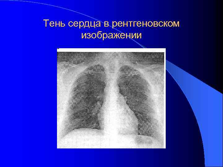 Тень сердца в рентгеновском изображении 