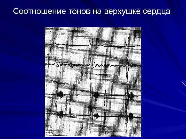 Соотношение тонов на верхушке сердца 