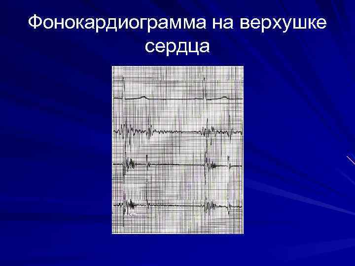 Фонокардиограмма на верхушке сердца 