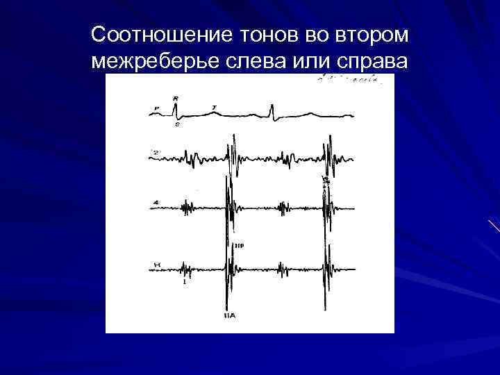 Соотношение тонов во втором межреберье слева или справа 